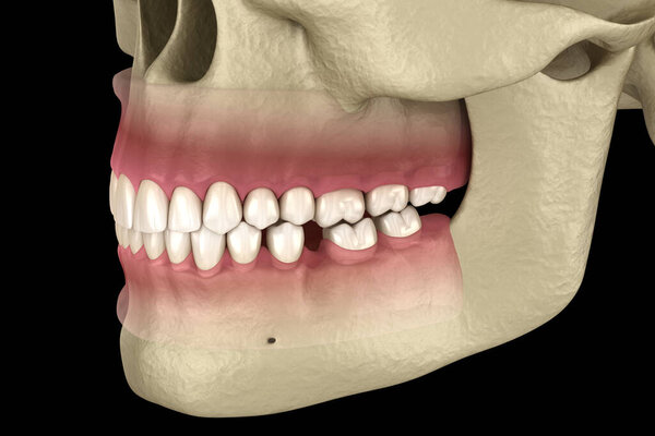 Teeth shift deformatiuon after losing molar tooth. 3D illustration of Popov Godon phenomenon