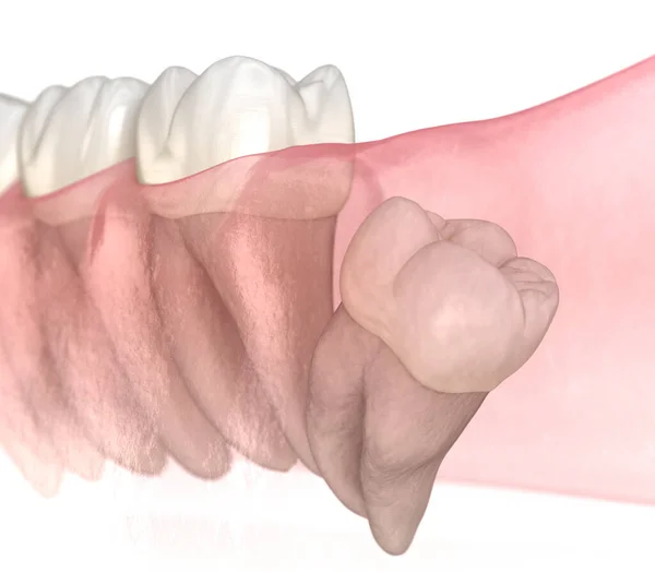 Дистальное Повреждение Зуба Мудрости Медицинская Точность Трехмерной Иллюстрации Зубов — стоковое фото