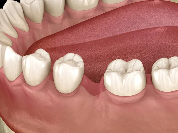 Dentes Deslocar Deformatiuon Depois Perder Dente Molar Ilustração Fenômeno Popov — Fotografia de Stock