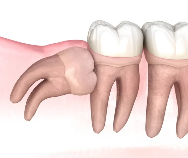 Poziome Uderzenie Zęba Mądrości Medycznie Dokładna Ilustracja Zęba — Zdjęcie stockowe