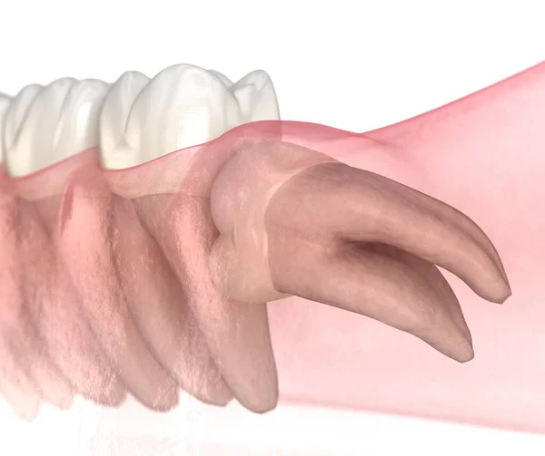 Horizontální Dopad Zubu Moudrosti Lékařsky Přesná Zubní Ilustrace — Stock fotografie