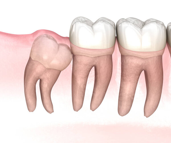 Mesial impaction of Wisdom tooth. Medically accurate tooth 3D illustration