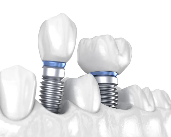 Instalación Corona Dentaria Premolar Molar Sobre Implante Concepto Blanco Ilustración — Foto de Stock