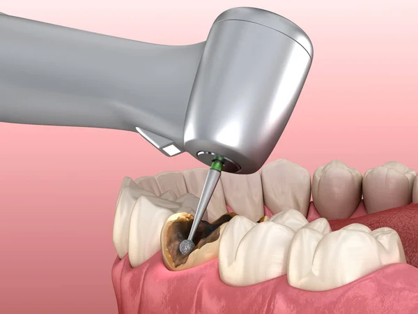 Caries Çıkarma Işlemi Tıbbi Olarak Doğru Diş Illüstrasyon — Stok fotoğraf