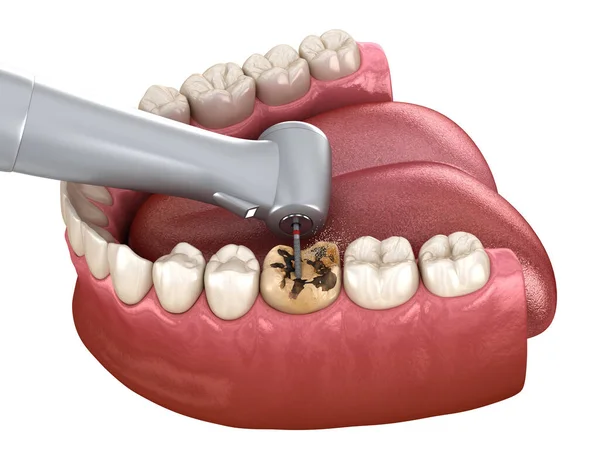 Caries Çıkarma Işlemi Tıbbi Olarak Doğru Diş Illüstrasyon — Stok fotoğraf