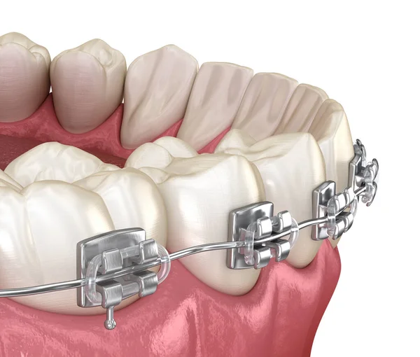 Dentes Saudáveis Com Aparelho Metal Vista Macro Ilustração Odontológica Medicamente — Fotografia de Stock