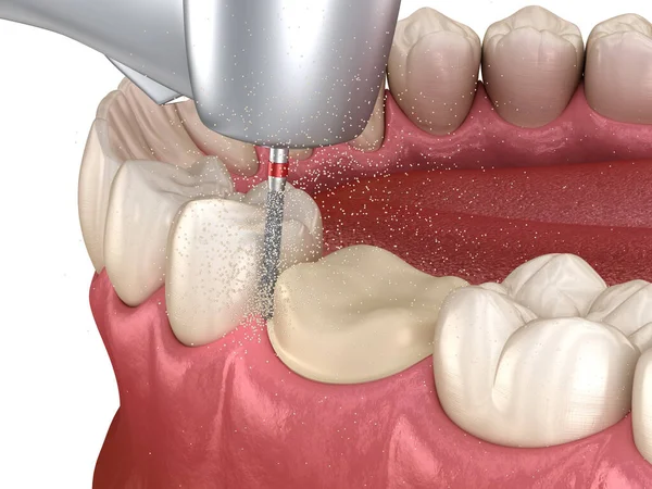 Molaire Voorbereiding Proces Voor Tandheelkundige Kroon Plaatsing Medisch Accurate Illustratie — Stockfoto