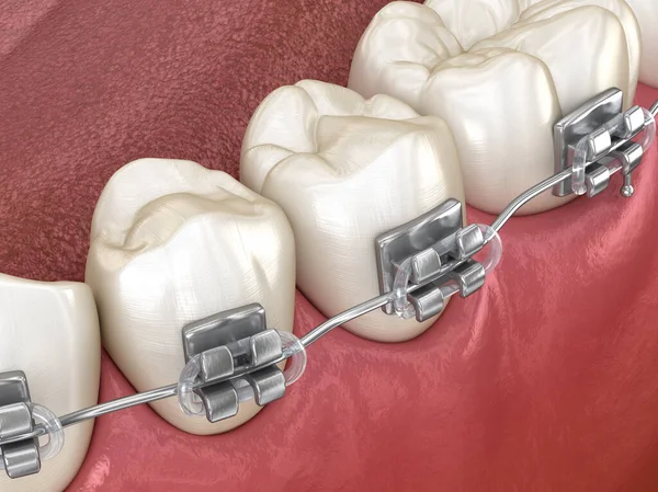 Здорові Зуби Металевими Брекетами Вид Макро Медично Точна Стоматологічна Ілюстрація — стокове фото