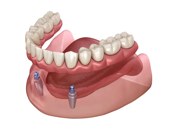 Alt Çene Çıkarılabilir Protez Hepsi Top Eklentili Implantlar Tarafından Desteklenen — Stok fotoğraf