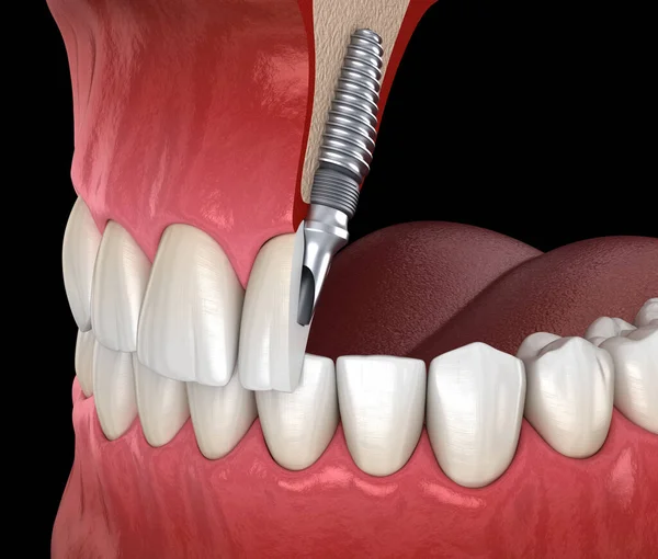 Central Incisor Återhämtning Genom Implantat Medicinskt Korrekt Illustration Dental Concept — Stockfoto