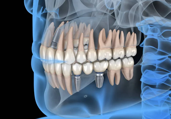 インプラントによる中央切開器の回復 歯科概念の医学的に正確な3Dイラスト — ストック写真