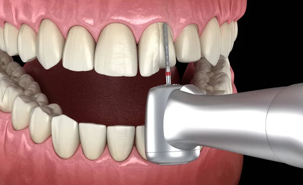 Diş Kaplaması Yerleştirme Için Merkezi Incisor Hazırlama Işlemi Tıbbi Olarak — Stok fotoğraf