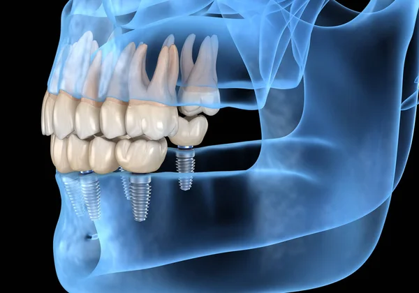 Prótesis Mandibular Todo Sistemas Soportado Por Implantes Ilustración Médicamente Precisa —  Fotos de Stock