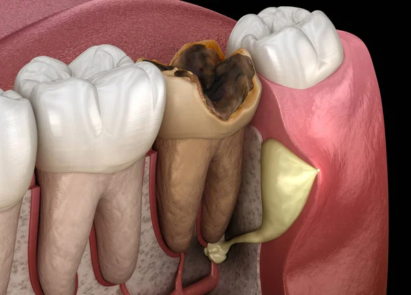 Parostitis Zahn Knoten Auf Dem Zahnfleisch Über Dem Zahn Medizinisch — Stockfoto