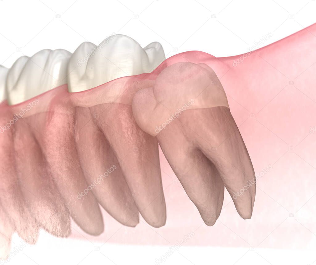Mesial impaction of Wisdom tooth. Medically accurate tooth 3D illustration