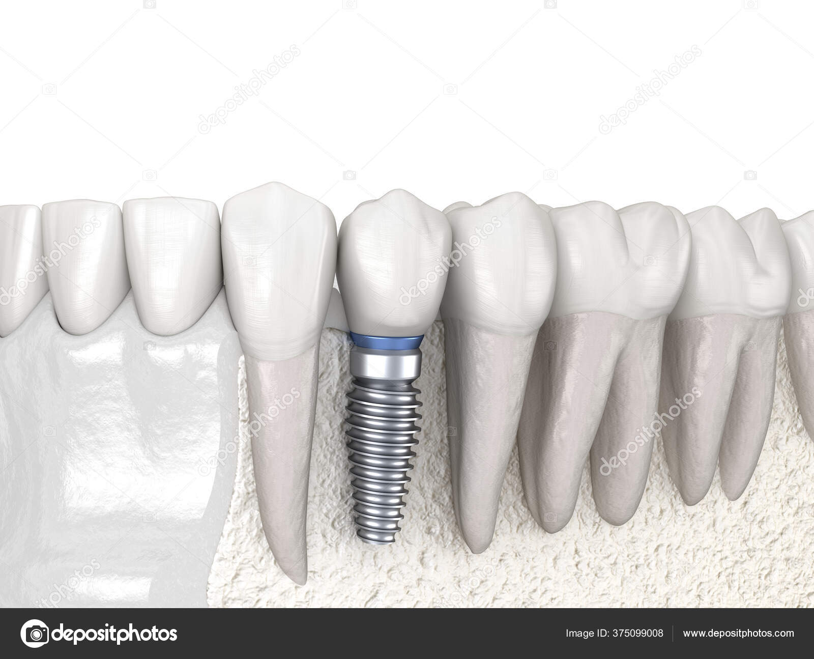 Premolar Tooth Recovery Implant Medically Accurate Illustration Human