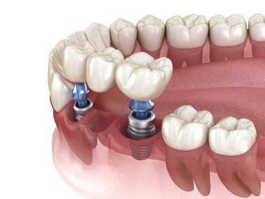 Diş köprüsü implantlarla destekleniyor. İnsan dişleri ve protez kavramının tıbben doğru üç boyutlu çizimi