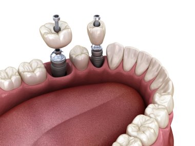 Azı dişi ve azı dişi yerleştirme implantın üzerine, vida saplantısı. Diş tedavisinin 3B illüstrasyonu