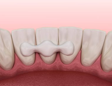 Maryland bridge made from ceramic, front tooth recovery. Medically accurate 3D illustration of dental concept clipart