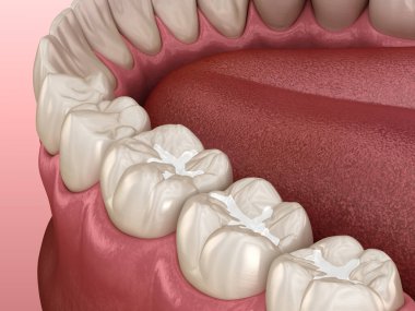 Molar Fissure diş dolguları, diş konseptinin tıbbi olarak doğru üç boyutlu çizimi