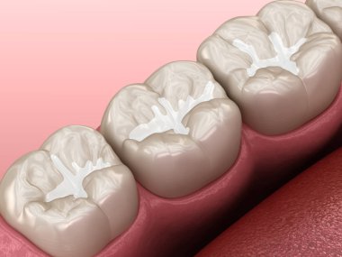 Molar Fissure diş dolguları, diş konseptinin tıbbi olarak doğru üç boyutlu çizimi