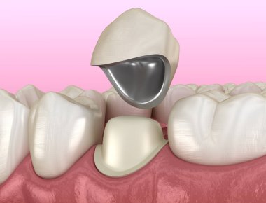 Hazırlanmış azı dişi ve diş metal seramik kaplama. Tıbbi olarak doğru 3d illüstrasyon