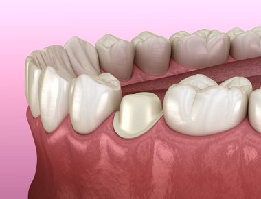 Metal-seramik diş yerleştirme için hazırlanmış azı dişi. Tıbbi olarak doğru 3B illüstrasyon