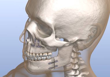 Maxillomandibular ilerlemiş ameliyat. Tıbbi olarak doğru olan 3 boyutlu diş illüstrasyonu.