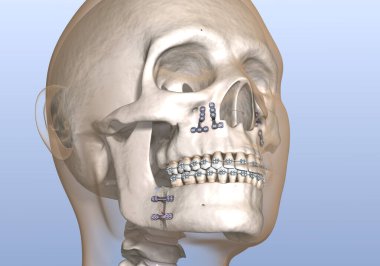 Maxillomandibular ilerlemiş ameliyat. Tıbbi olarak doğru olan 3 boyutlu diş illüstrasyonu.