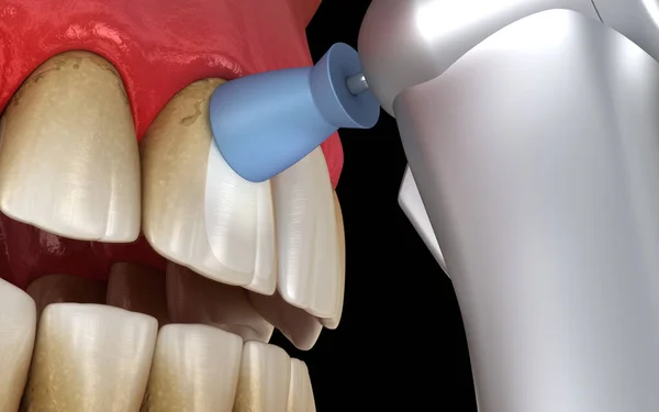 Tanden Polijsten Procedure Met Professionele Borstel Gel Medisch Accurate Illustratie — Stockfoto