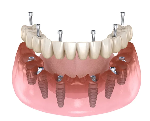 Prothèse Mandibulaire Tout Sur Système Soutenu Par Des Implants Fixation — Photo