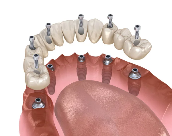 Prótesis Mandibular Todo Sistema Soportado Por Implantes Fijación Tornillo Ilustración — Foto de Stock