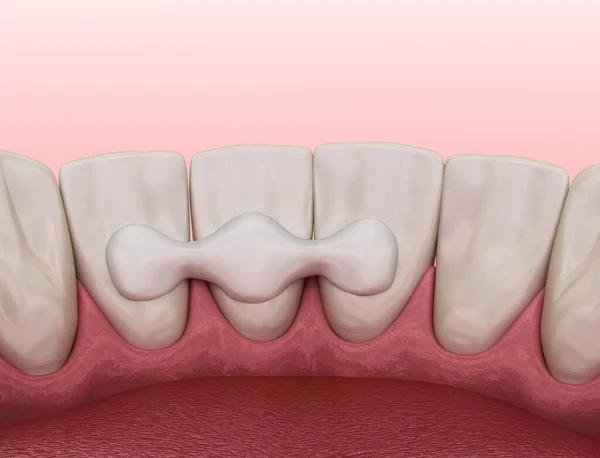 马里兰桥由陶瓷制成 前牙修复 牙科概念的医学上准确的3D图像 — 图库照片