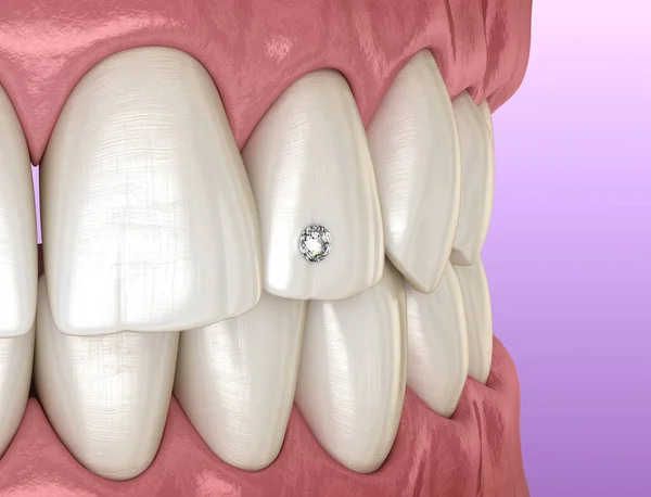 Przekłuwanie Zębów Diamentem Koncepcja Ilustracji — Zdjęcie stockowe