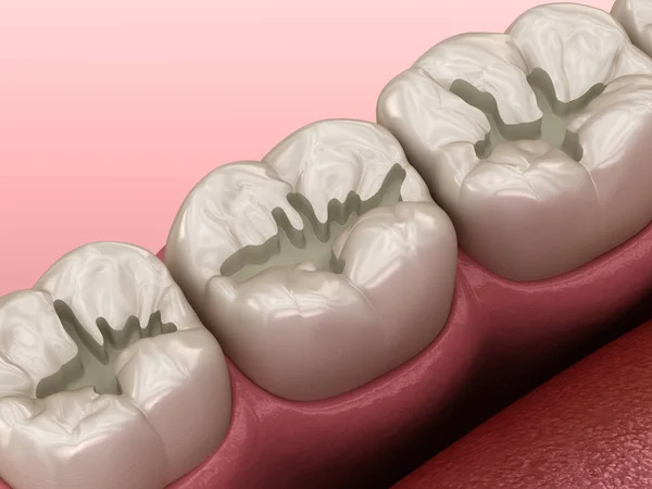 Propared Molar Fissure Fillings Placement Medically — 스톡 사진