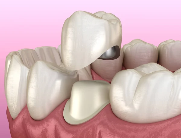 Przygotowany Ząb Przedtrzonowy Korona Metalowo Ceramiczna Medycznie Dokładna Ilustracja — Zdjęcie stockowe