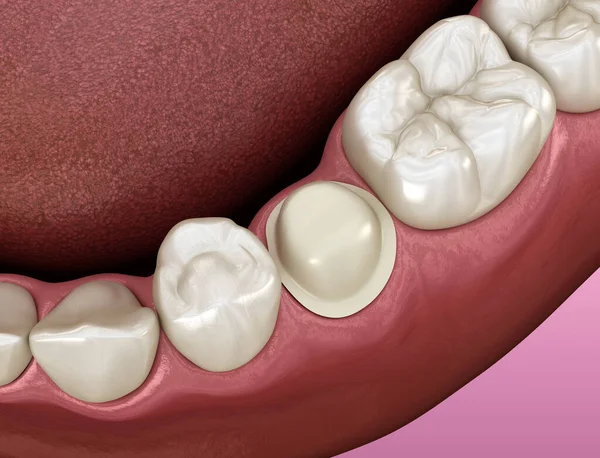 Voorbereide Premolaire Tand Voor Tandheelkundig Metaal Keramische Kroon Plaatsing Medisch — Stockfoto