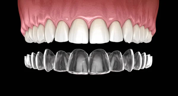 ブレースや目に見えない家臣を調査する 医学的に正確な歯科3Dイラスト — ストック写真