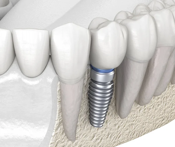 Récupération Prémolaire Des Dents Avec Implant Illustration Médicalement Précise Concept — Photo