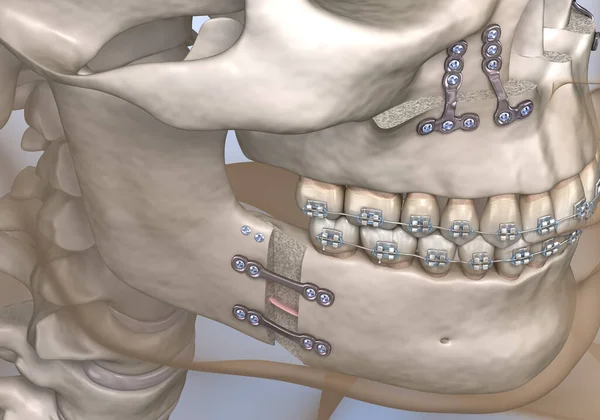Kieferorthopädiechirurgie Medizinisch Korrekte Zahnärztliche Illustration — Stockfoto
