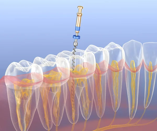 Endodontic root canal treatment process. Medically accurate tooth 3D illustration.