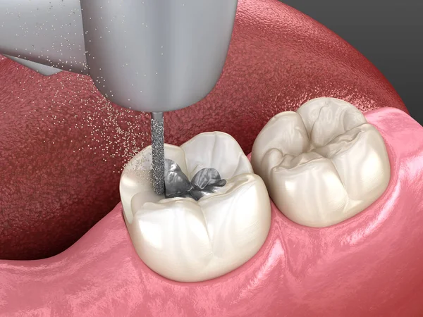 海藻酰胺的去除及陶瓷冠放置的准备工作 牙科概念的三维图解 — 图库照片