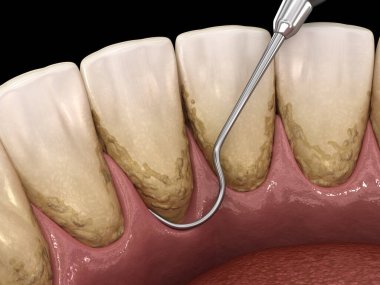 Ağız temizliği: Ölçekleme ve kök planlama (geleneksel periodontal terapi). İnsan diş tedavisinin tıbbi açıdan doğru üç boyutlu çizimi