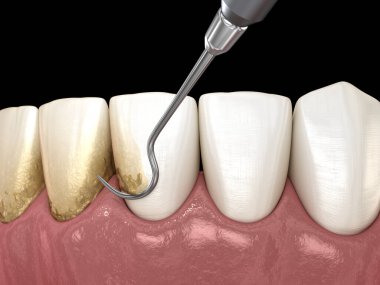 Ağız temizliği: Ölçekleme ve kök planlama (geleneksel periodontal terapi). İnsan diş tedavisinin tıbbi açıdan doğru üç boyutlu çizimi