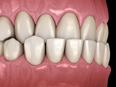 Underbite diş tıkanıklığı ( Dişlerin maloklüzyon ). Tıbbi olarak doğru diş 3d illüstrasyon