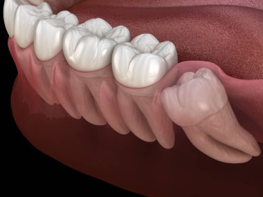 Azı dişinde darbeli bilgelik dişi. Tıbbi olarak doğru diş 3d illüstrasyon