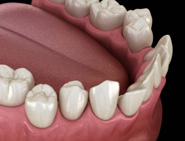 Anormal diş pozisyonu, ortodontik kavram. Tıbbi olarak doğru diş 3d illüstrasyon