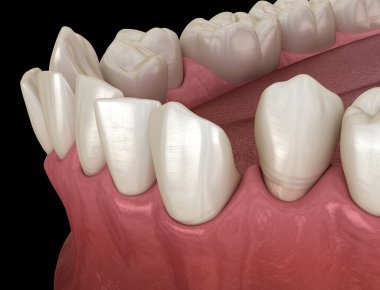 Anormal diş pozisyonu, ortodontik kavram. Tıbbi olarak doğru diş 3d illüstrasyon