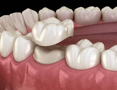 Diş kaplaması yerleştirme için hazırlanmış azı dişi. Tıbbi olarak doğru 3B illüstrasyon