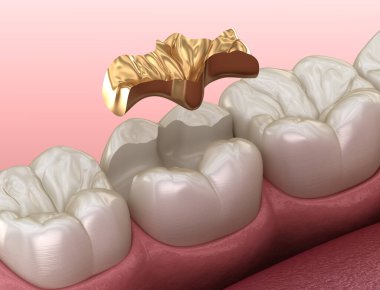 Altın Kalık taç diş üzerinde fiksasyon. İnsan diş tedavisi tıbbi olarak doğru 3d illüstrasyon